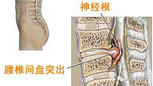 一次下蹲对腰椎融合术影响吗_蹲着可以治疗腰椎间盘突出吗_腰椎间盘手术后多长时间可以蹲下身子