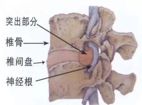 蹲着可以治疗腰椎间盘突出吗_一次下蹲对腰椎融合术影响吗_腰椎间盘手术后多长时间可以蹲下身子