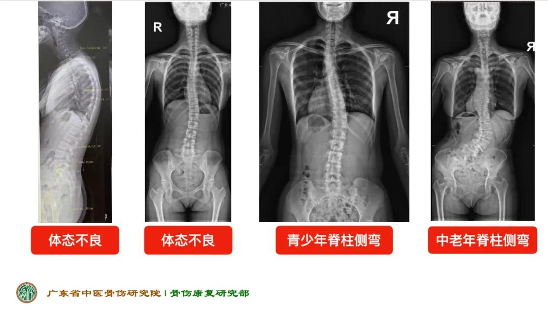 脊柱侧弯要不要告诉男朋友_脊柱侧弯被男朋友嫌弃_男朋友脊柱侧弯有点担心以后